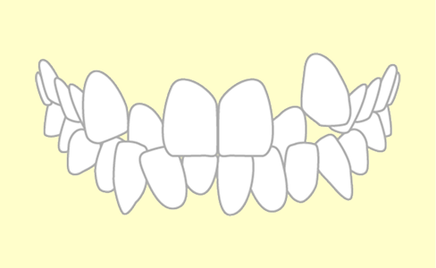 叢生の歯並び