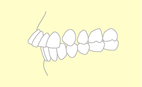 上アゴ前突の歯並び