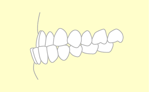 下アゴ前突の歯並び