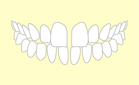 すきっ歯の歯並び
