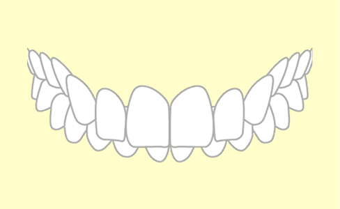 過蓋咬合の歯並び