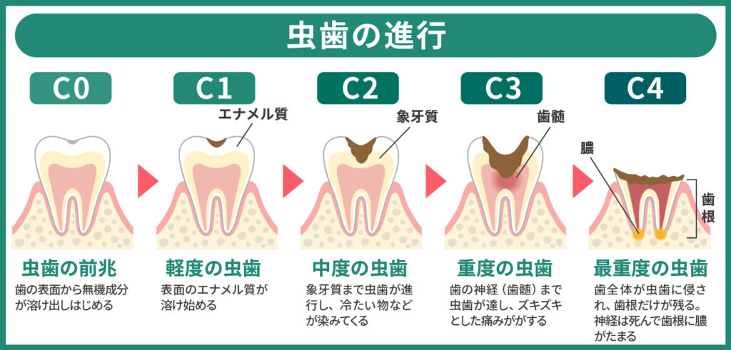 虫歯の進行