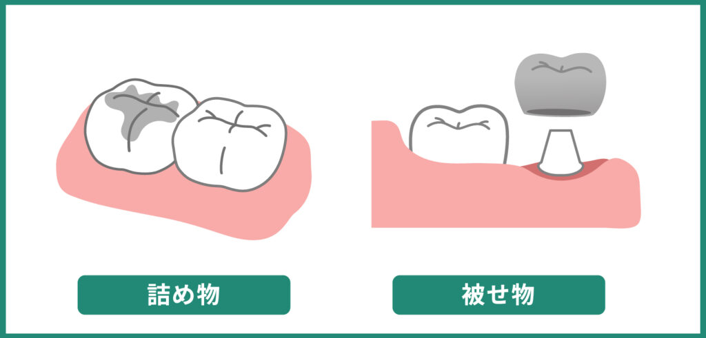 調布での詰め物・被せ物とは？