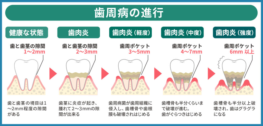 歯周病の進行