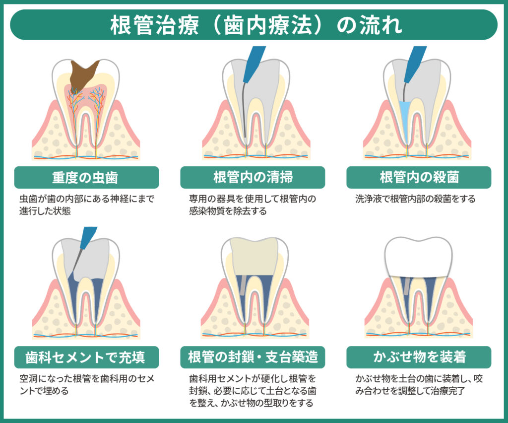 根管治療（歯内療法）の流れ