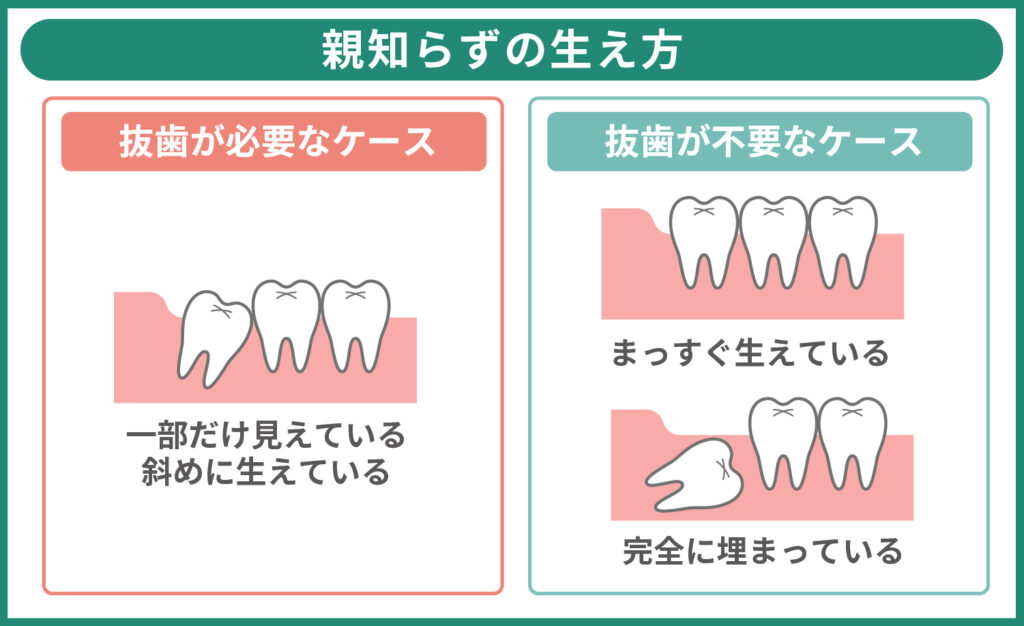 親知らずの生え方