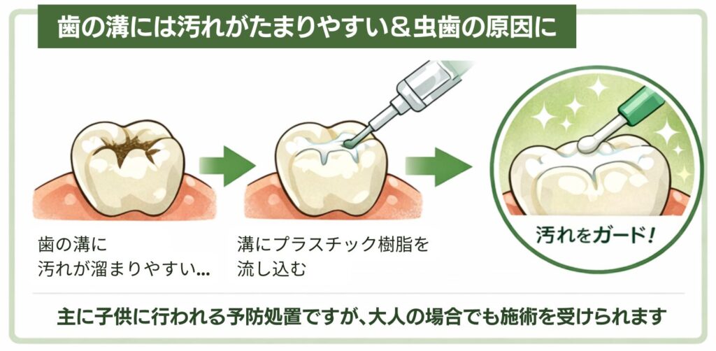 シーラントについて|調布歯科・かおいく矯正歯科
